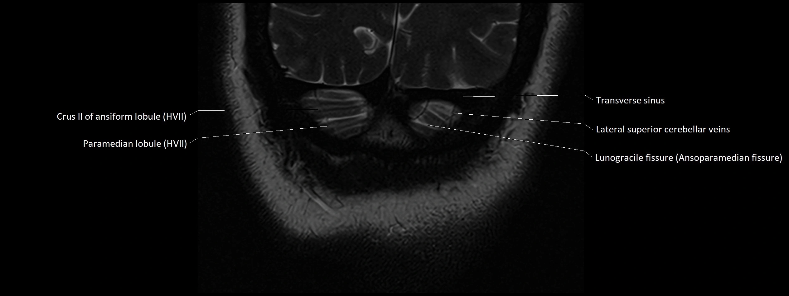 Anatomy of cerebellum coronal cross sectional 3T image 32.webp